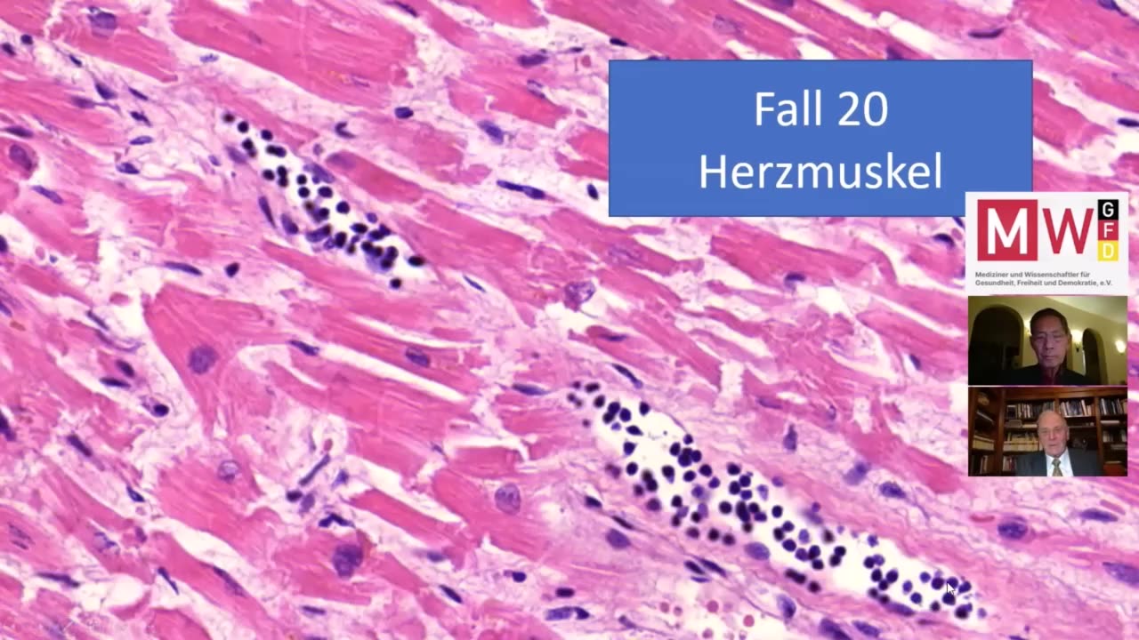 Prof. Arne Burkhardt: Covid-19 “vaccines” can induce self-destruction