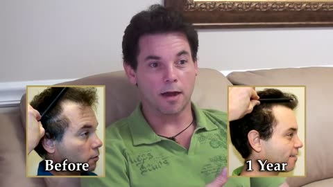 Hair Transplant Results | Dr. Brett Bolton MaxHarvest™ Procedure