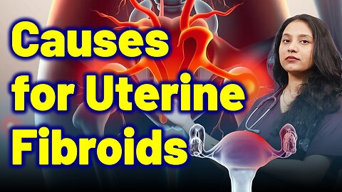 Important Causes of Utrine Fibroids | Treatment Cure Medicine Surgery | Gynaecology Women Female |