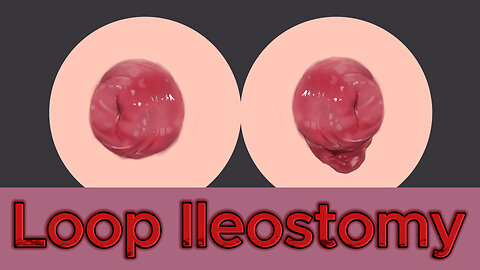 Ep.5 | Loop ileostomy