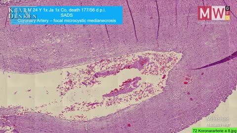 Pressekonferenz 15.03.2023 Prof. Dr. Arne Burkhardt