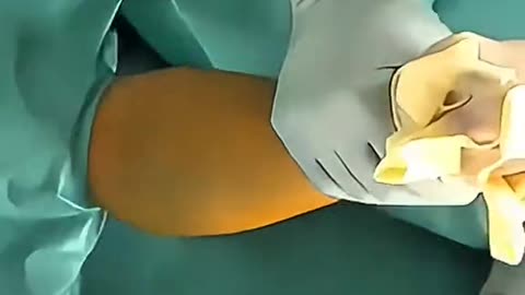 Radius Plating Surgery