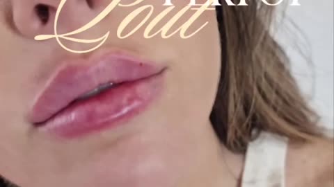 Lip Filler Windsor – Natural Pout Enhancements at Bare Brilliance