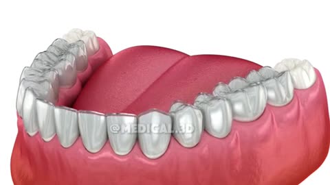 How Invisalign Teeth Aligners Works