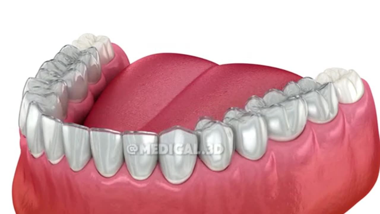 How Invisalign Teeth Aligners Works