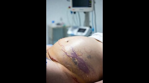 Abdominal ascites #3dmedico #medical