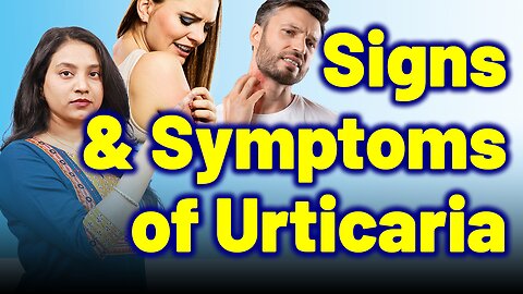 Symptoms and Signs of Urticaria, Nettle rash, Hives, Wheals. | Treatment Cure | SkinAllergy