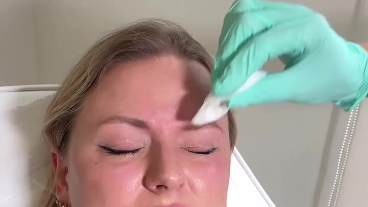 Wrinkle Treatment in Windsor – Natural Results at Bare Brilliance