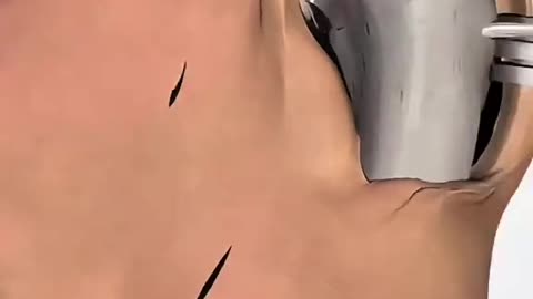 Bunion Correction Surgery