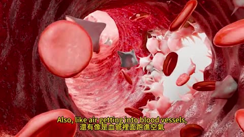 纖維肌痛 高壓氧治療