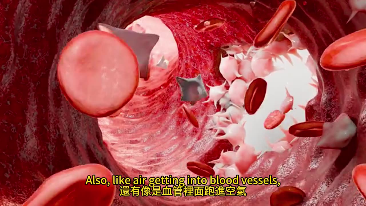 纖維肌痛 高壓氧治療