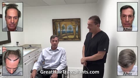 Dr. Brett Bolton Repairs Bosley Result with MaxHarvest™ Plus for Patient Mike