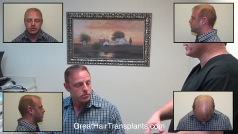 Great Hair Transplants: Dr. Brett Bolton Fixes Failed FUE for Patient Jesse
