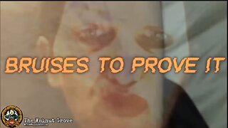 Bruises to Prove It - The Walnut Grove