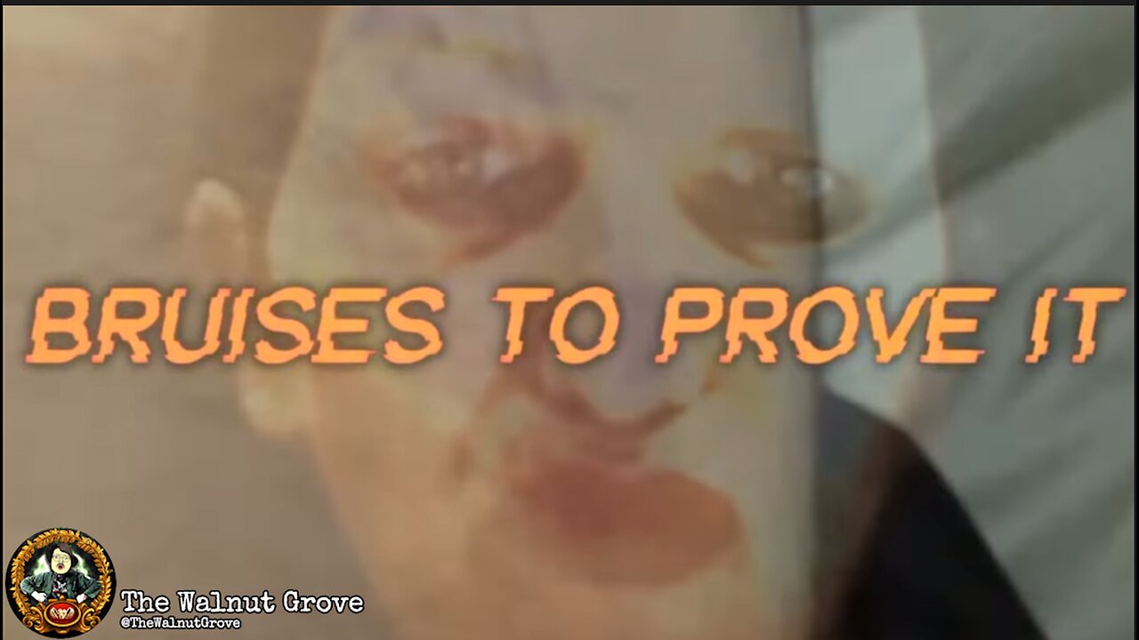 Bruises to Prove It - The Walnut Grove