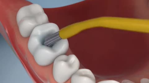 Composite Filling Dental Procedure 3D Animation