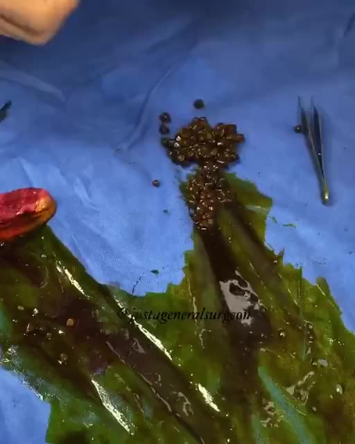 Have you ever seen a gallbladder cut open and gallstones taken out?