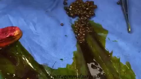 Have you ever seen a gallbladder cut open and gallstones taken out?