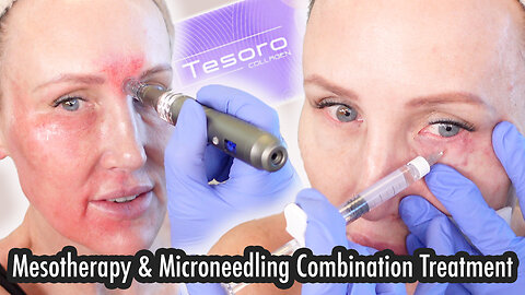 Tesoro Collagen Mesotherapy & Microneedling - Acecosm.com discount code STACY10