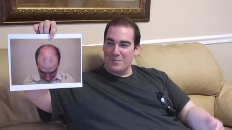 Dr. Brett Bolton Delivers Incredible Hair Transplant Transformation