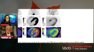 A Shocking Discovery In PET/CT Scans Of The Hearts Of The Covid Vaccinated