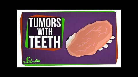 Teratomas: What Tumors with Teeth Can Teach Us About Stem Cells