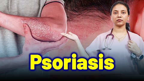 Psoriasis,Chronic Plaque,Erythrodermic,Guttate.| Treatment Cure Relief Medicine | Skin Hair Nail |