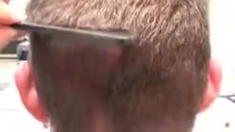 Dr. Brett Bolton Hair Implant Scar – Undetectable Results After Hair Transplant