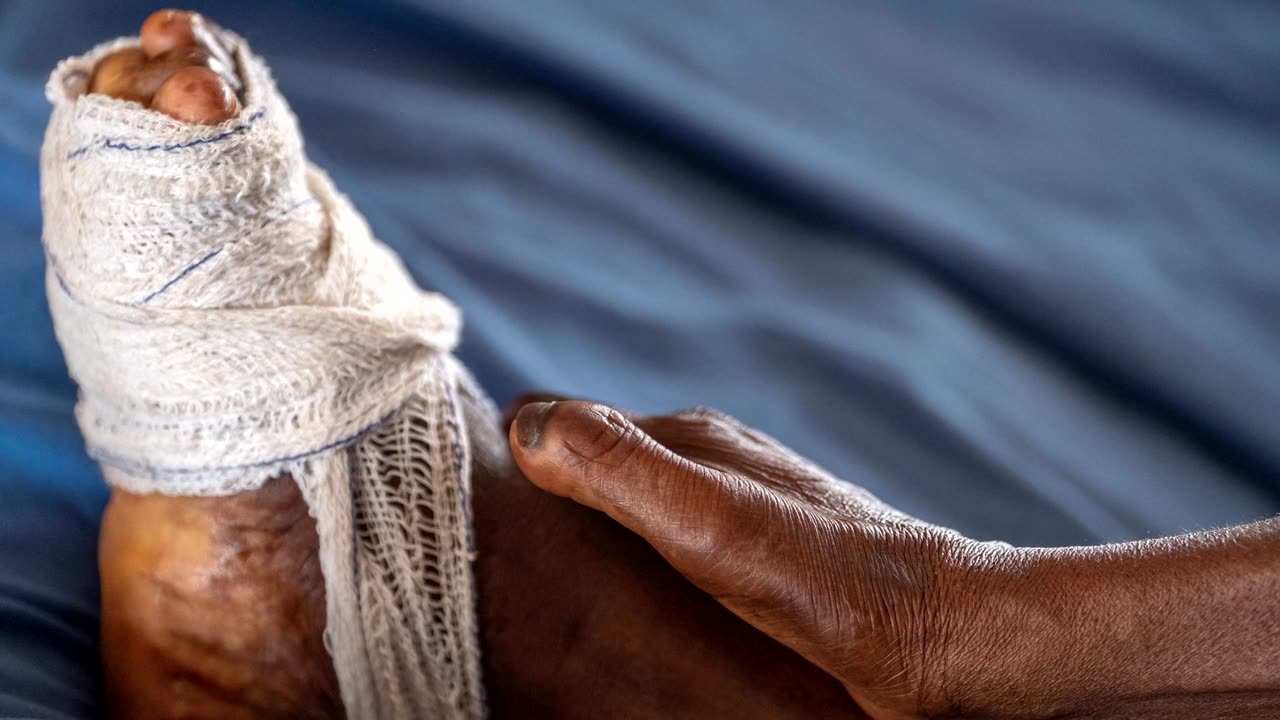 Nigeria to receive leprosy drugs after a year-long delay