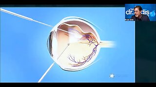 The Dr Ardis Show_Cataracts_What Your Doctor Won’t Tell You Part 1