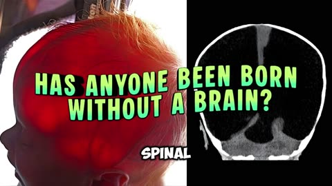 Has anyone been born without a brain?