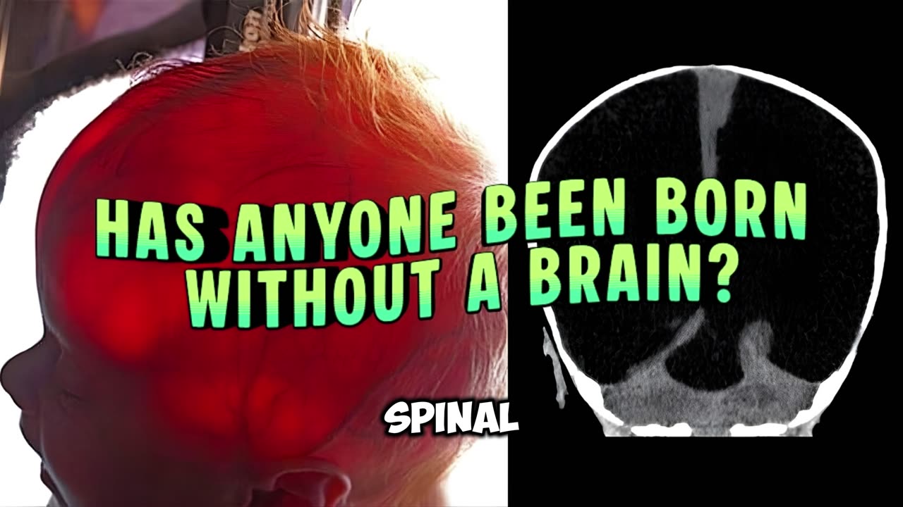 Has anyone been born without a brain?