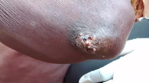 Look how scary jigger removal can be, Don't watch!!