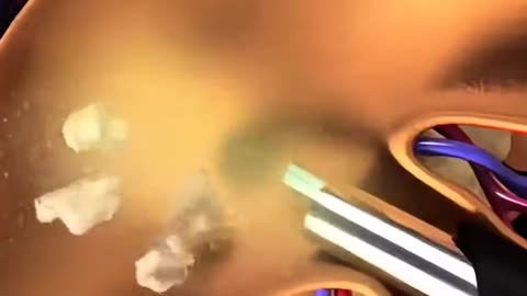 PCNL Procedure – Kidney Stone Removal Surgery Step by Step