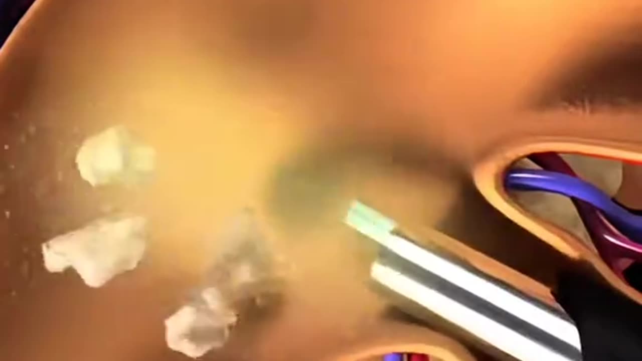 PCNL Procedure – Kidney Stone Removal Surgery Step by Step