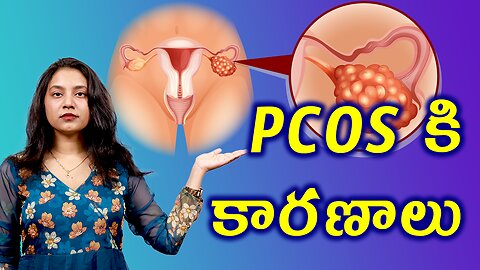 PCOS కి కారణాలు Cause and Risk Factors for PCOS or PCOD Treatment Cure | హోమియోపతి