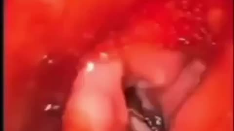 Worms in your Lungs Causing Coughing?