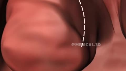 Tonsil and Adenoid Removal Surgery (Adenotonsillectomy)