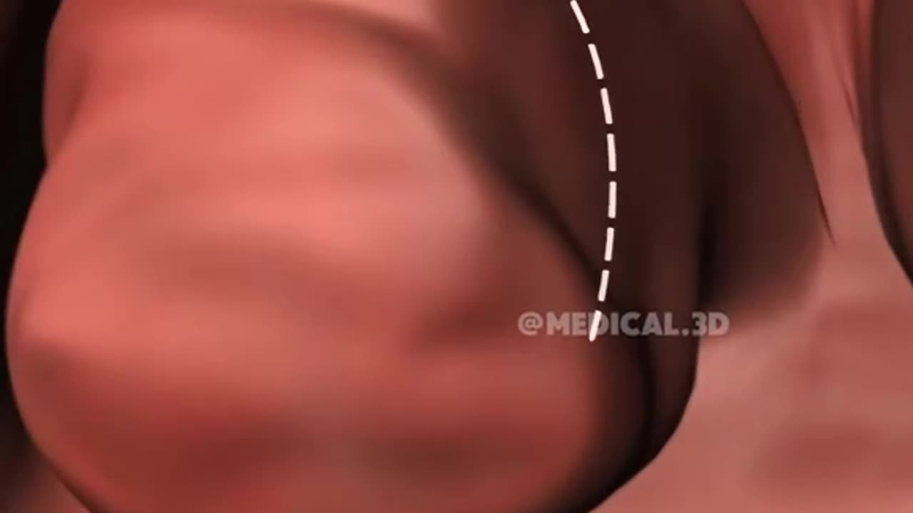 Tonsil and Adenoid Removal Surgery (Adenotonsillectomy)