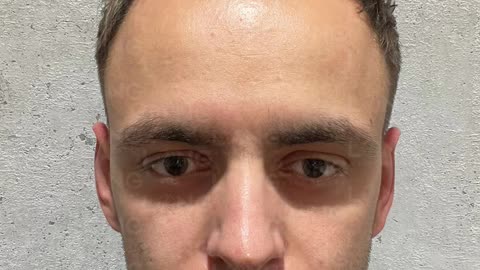 A Before and after result of a hair transplant done at Long Hair Centre.