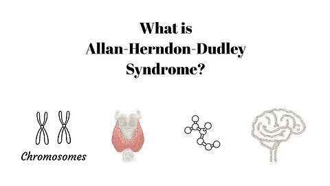 What is Allan Herndon Dudley Syndrome?