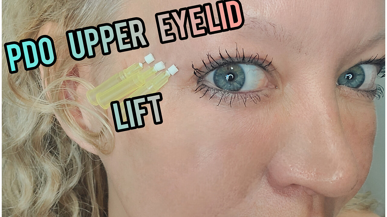 PDO Facial Threads for Orbital Ridge Upper Eyelid Edited Version😍