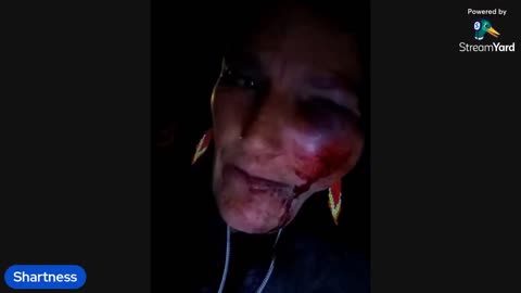 Honeyholic Crashes Her Ebike Aftermath