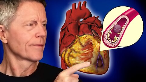 How to Predict Your Heart Attack Risk AT HOME