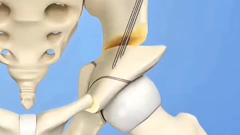 Child Hip Dysplasia Surgery Pediatric Hip Correction Explained