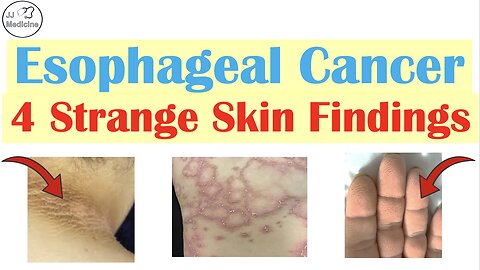 4 Skin Findings That Can Reveal Esophageal Cancer Early