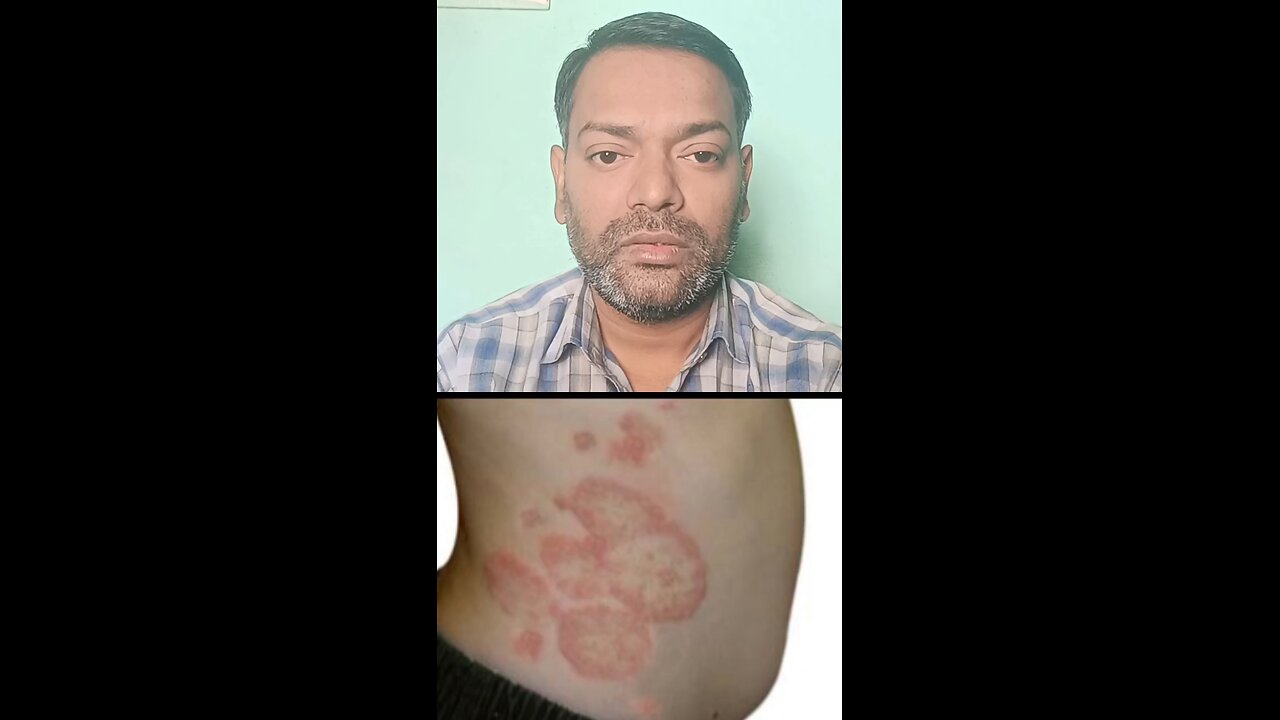 लाल दाद का इलाज ।