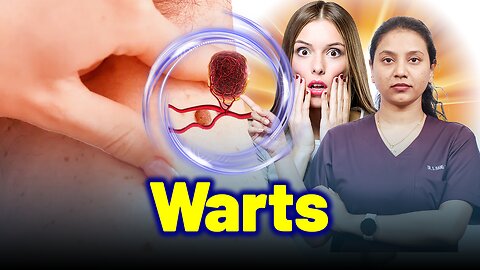 Warts, Flat Warts, Plantar Warts,Papilloma.| Treatment & Cure | Homeopathy, Medicine & Surgery