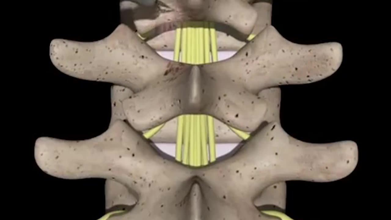 SpinaL Cord Surgery 3D Animation (Lumbar Surgery)