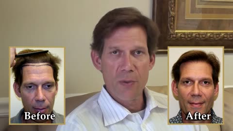 Dr. Brett Bolton Hair Transplant Timeline | Expert in Hair Restoration Industry (Short Version)